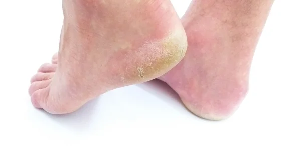 5 exercises for Plantar fasciitis