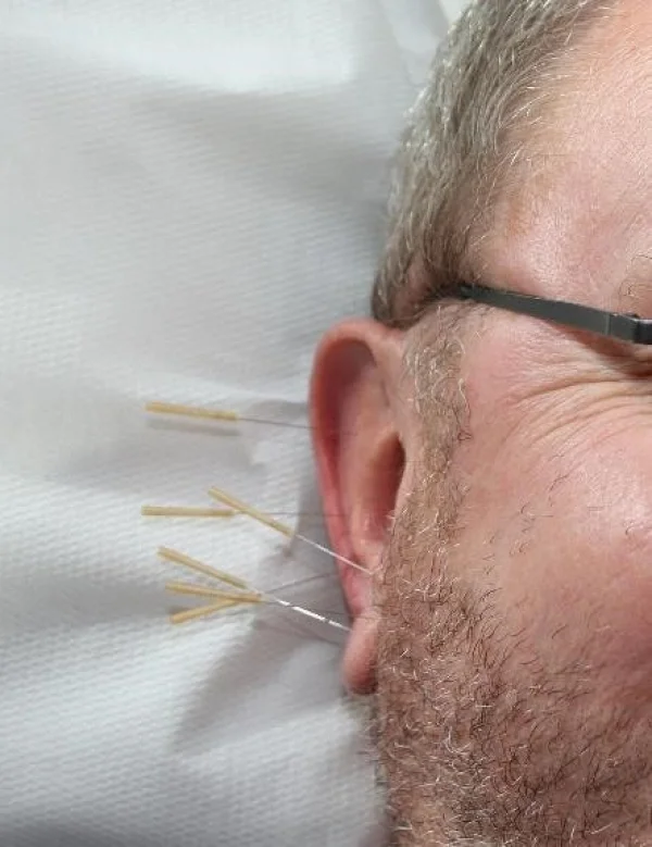 Needles in your ear can help your health...