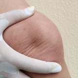 Osgood–Schlatter disease