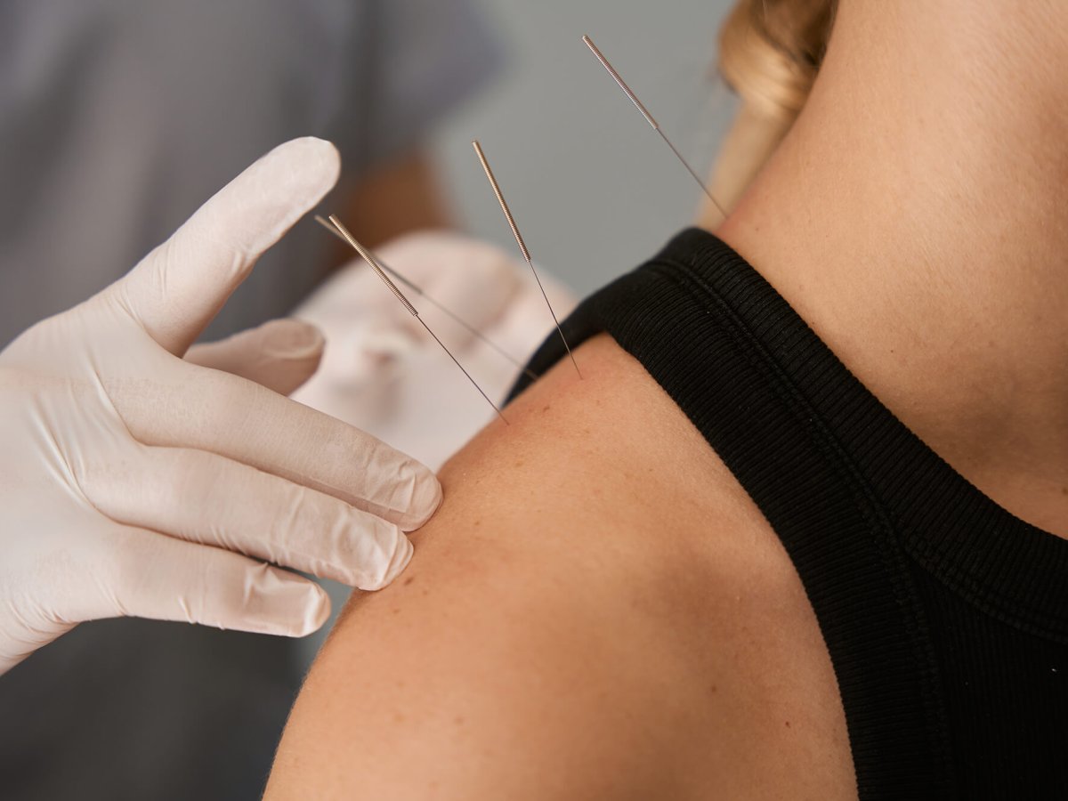 Acupuncture