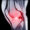 Anterior Cruciate Ligament (ACL) Injury: Repair & Reconstruction